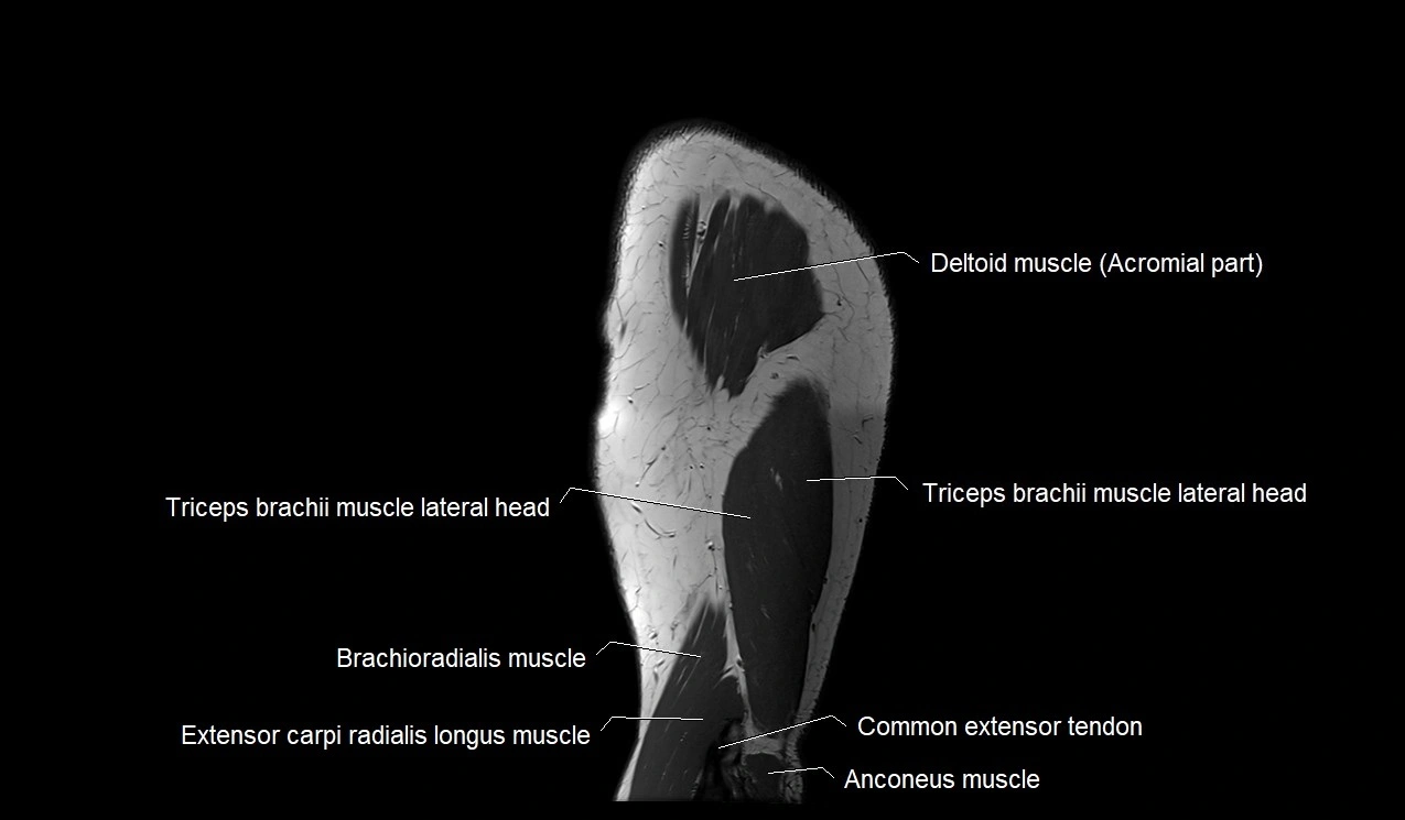 Upper arm (humerus ) saittal cross sectional anatomy 3T image 4.webp